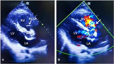 Application of extracorporeal membrane oxygenation in the remote transport of a patient with a ruptured sinus of Valsalva aneurysm: a case report